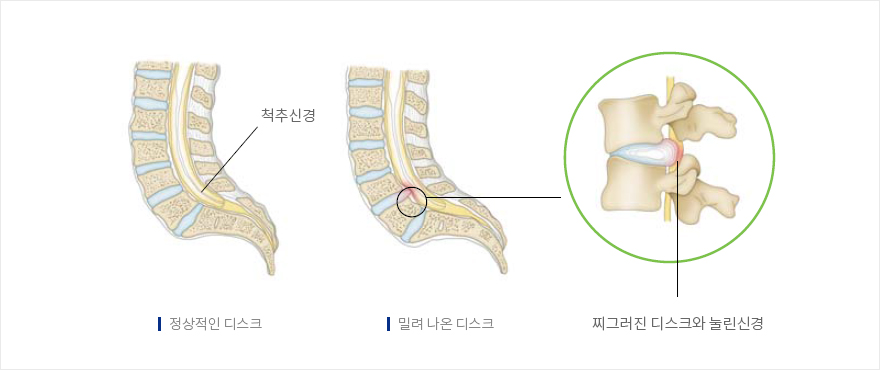 정상적인 디스크, 밀려나온 디스크, 찌그러진 디스크와 눌린신경 | 자생의료재단