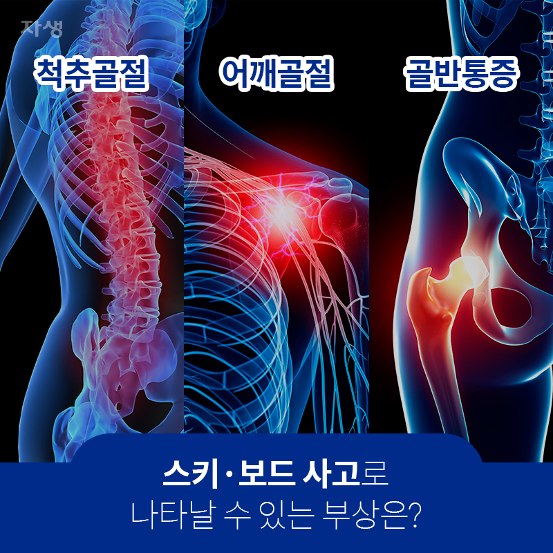 스키ㆍ보드 사고로 나타날 수 있는 부상은? 척추골절 / 어깨골절 / 골반통증 | 자생한방병원ㆍ자생의료재단