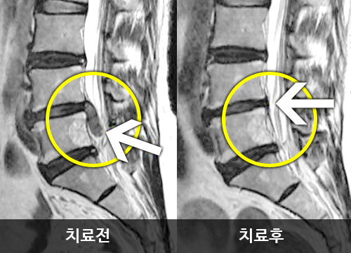 코모리 구분법 상 class 3에 해당되는 디스크 환자가 한방통합치료 후 class 1로 호전된 치료전후 MRI - 자생한방병원